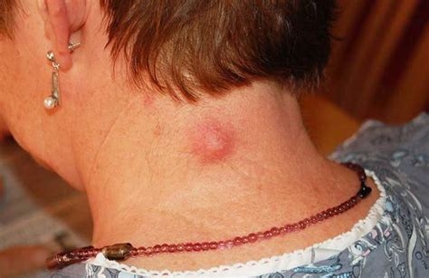 Home Remedies For A Boil On The Neck — Healthy Builderz