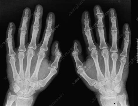 Osteoarthritis In The Hands X Ray Stock Image C0168214 Science