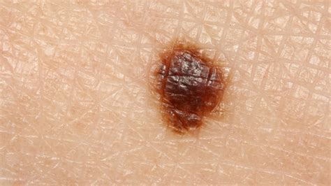 Moles Nevus News And Updates At Statenclinic
