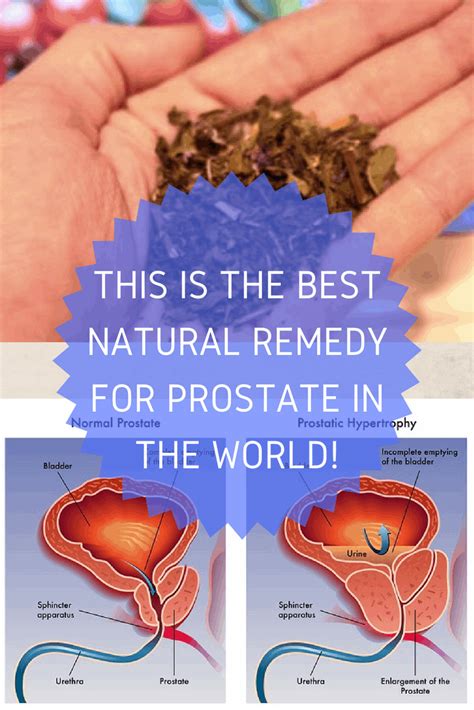 This Is The Best Natural Remedy For Prostate In The World Prostate