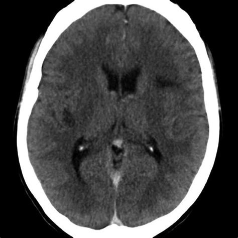 Contrast Enhanced Ct Of The Brain Showing Cerebral Abscesses In The
