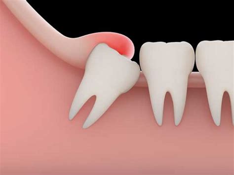 Wisdom Teeth Diagram Fivecorner