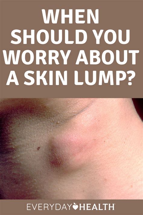 When Should You Worry About A Skin Lump Epidermoid Cyst Skin Treat