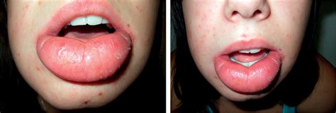 swelling lips icd 10