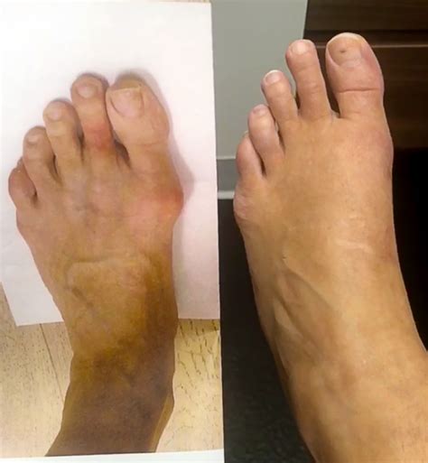 Before And After Photo And Video Results Gallery The Bunion King