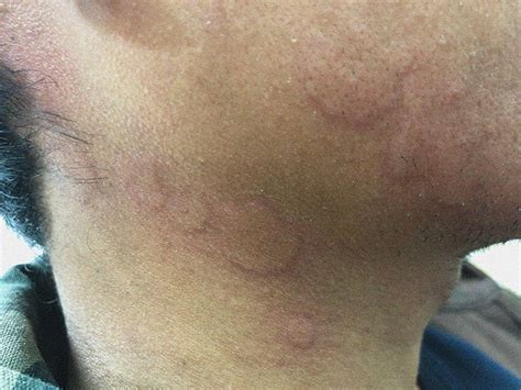 Dry Red Itchy Skin On Face And Neck