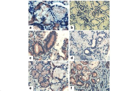 Thymosin β 4 Tβ 4 And Tβ 10 Immunostaining In Patients With Primary