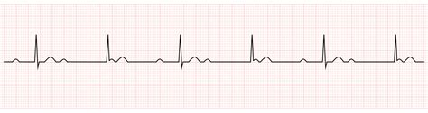 Electrocardiograma Que Muestra Bloqueo Av Completo O De Tercer Grado