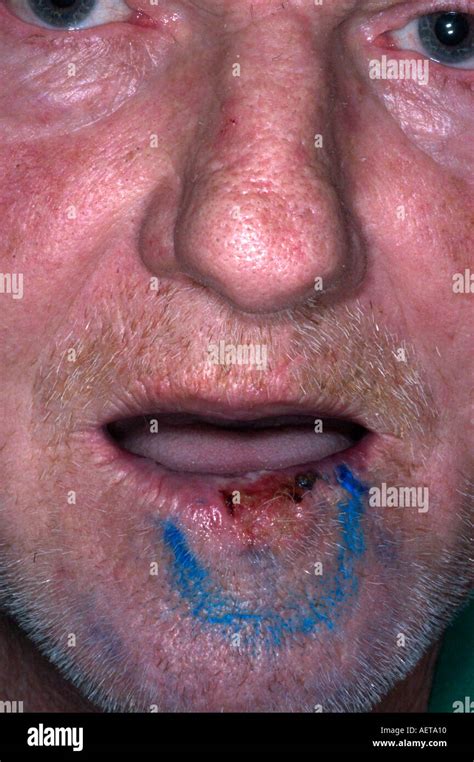Squamous Cell Carcinoma Of The Lip The Blue Markings Are Used To Stock