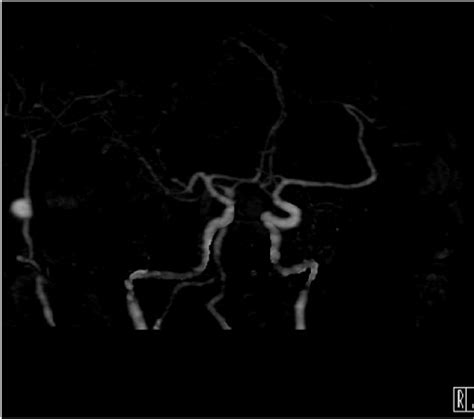 Computed Tomography Angiography Shows A Superficial Temporal Artery