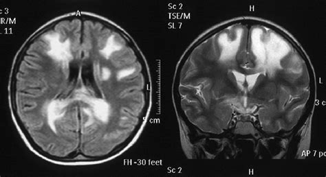 T2 Weighted Mri Of Brain Showing Hyperintense Lesions In The