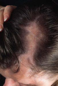 Small, dilated blood vessels under the skin's surface. The Link Between Pattern Hair Loss and Fibrosis (Collagen ...
