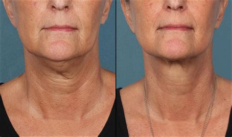 Kybella Before And After Photos Patient 2 Houston Tx Dermsurgery