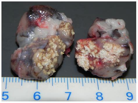 The cancer that starts in the lymphatic system, most likely shows symptoms like pain and swelling or either of the two. Bilateral tuberculosis-like lesions in the mandibular ...