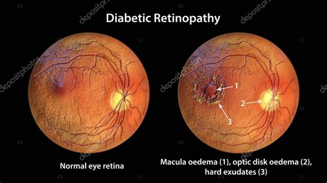 Diabetic Retinopathy 3d Illustration Showing Macula Edema Optic Disk