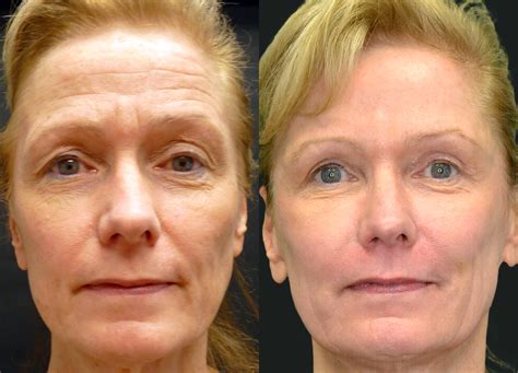 Laser Resurfacing In Northern Virginia Nova Plastic Surgery