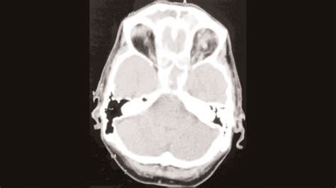 The Otorhinolaryngologist Cavernous Sinus Thrombosis A Potential