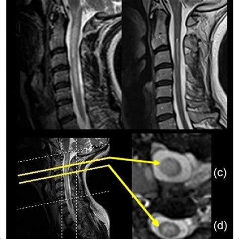 Gbs often starts a few days or weeks after an infection like the cold, flu, or stomach illness. Longitudinally extensive transverse myelitis lesion (C5-T1 ...