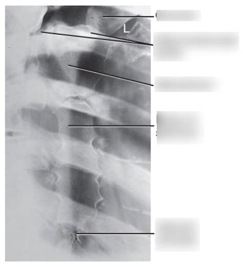 DIAGRAM Sternum Anatomy Oblique Sternal RAO X Ray 2018 Diagram