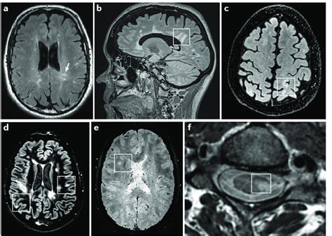 Typical Imaging Features Of Multiple Sclerosis With Conventional Mri