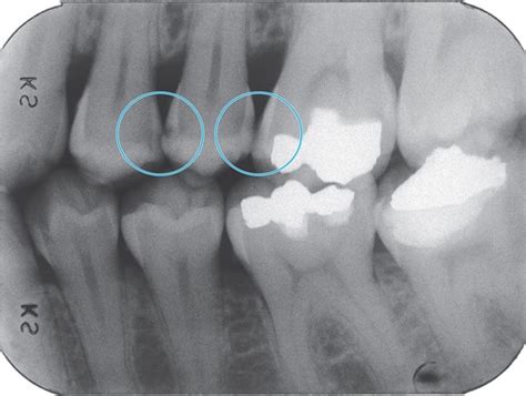 Radiology Ch 24 Dental Caries Flashcards Quizlet