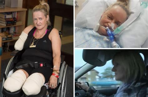 Scheme Tv Star Annie Caddis Has Both Legs And Right Arm Amputated After