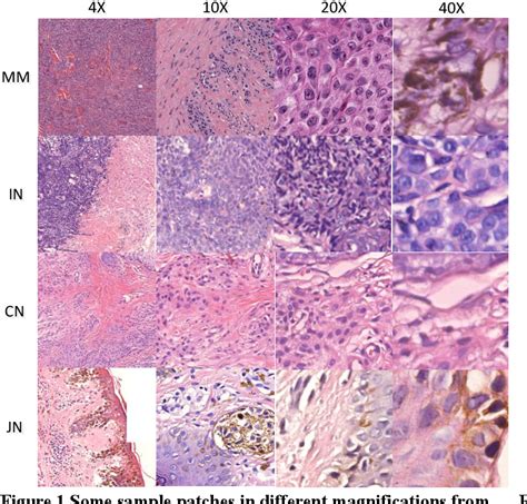 Figure 1 From Interpretable Classification From Skin Cancer Histology