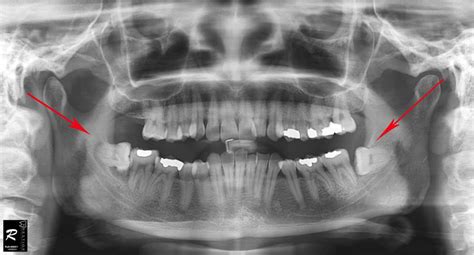 Wisdom Teeth Surgery Cases That Was Done In Our Clinic Prestige