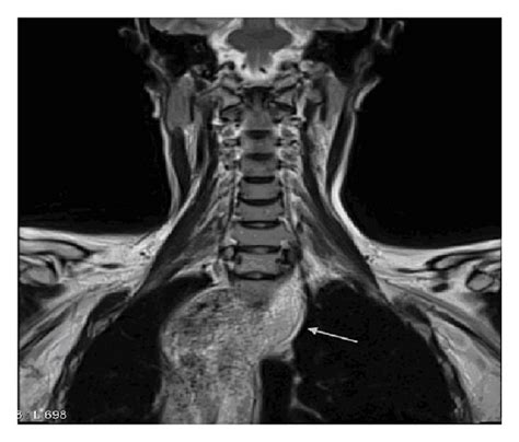 Mri Scan Of The Neck Region Showing The Extent Of The Esophageal