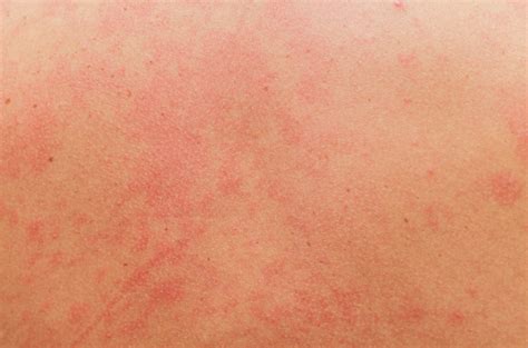 ¿sufres De Dermatitis Atópica Te Enseñamos Cómo Tratar La Piel En