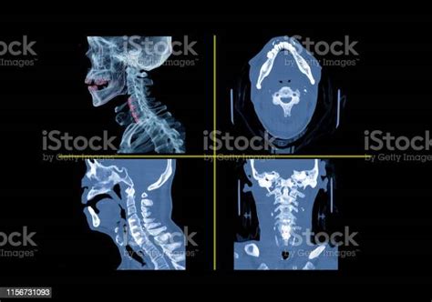 Comparison Of Ct Cspine Or Cervical Spine 3d Rendering Image Axial