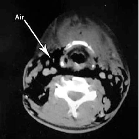Axial Neck Post Contrast Ct Shows Subcutaneous Air And The