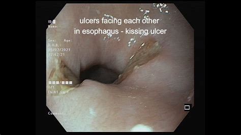 Kissing Esophageal Ulcer Youtube