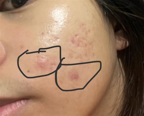 Acne Cystic Acne Scars Kinda Suck But Ive Been Dealing With Them