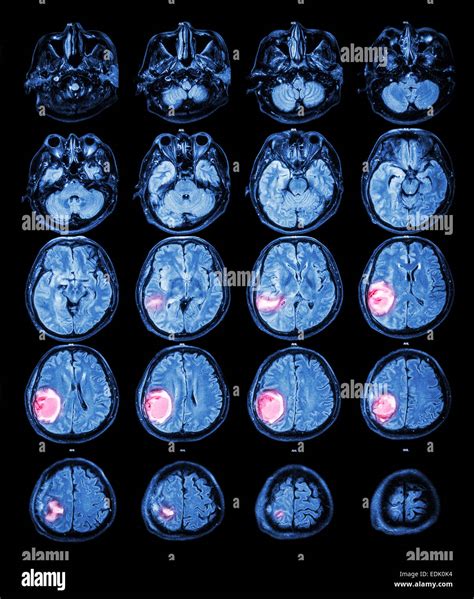 Mri Brain Tumor Hi Res Stock Photography And Images Alamy