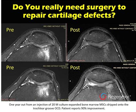 With wear and tear, cartilage gradually softens, then cracks, and finally develops large holes. What's Possible with Stem Cells Cartilage Regrowth ...