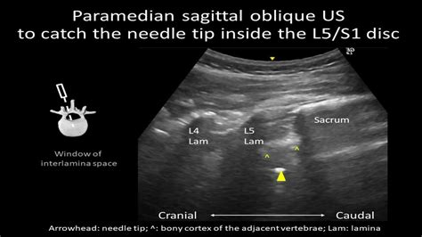 Ultrasound Guided Joint And Ligament Injections Our R