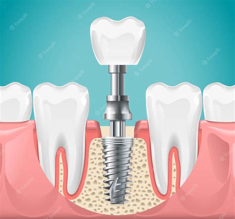 Premium Vector Dental Surgery Tooth Implant Cut Illustration