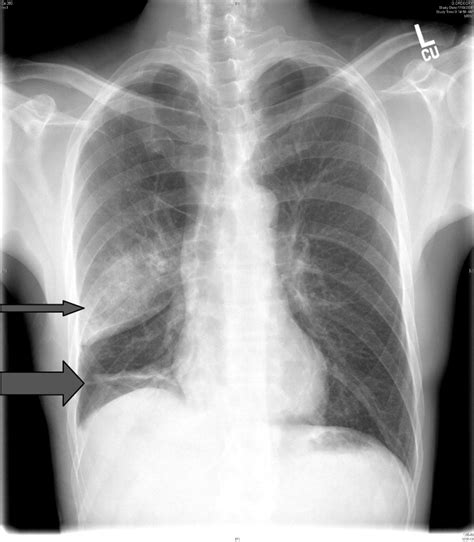 Also known as pneumothorax, collapsed lung is a rare condition that may cause chest pain and make it hard to breathe. Pneumothorax in a Patient With COPD | Journal of Hospital ...