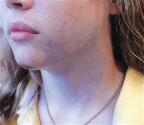 Bruising In A Teenage Girl A Manifestation Of Dermatitis Artefacta Consultant360