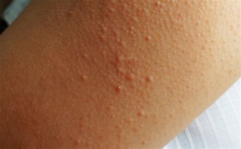 Keratosis Pilaris What You Need To Know