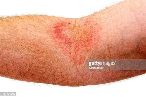 Red Rash Arm Imagens E Fotografias De Stock Getty Images