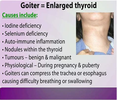 The Thyroid Goiter Thyroid Cure Tips
