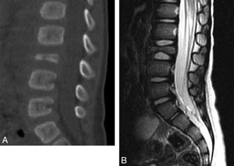 How to prevent herniated discs. Calvé-Syndrom || Med-koM