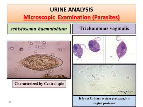 Parasite In Urine Under Microscope 3 Pus Cells Wbc Cast Bacteria