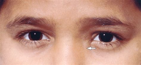 Lacrimal Sac Lymphoma In A Child Pediatric Cancer Jama