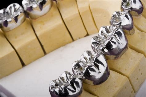 Full Metal Crown Semi Precious Vc Tech Dental Laboratory