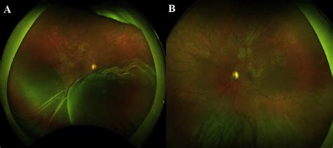 Exudative Retinal Detachment Color Fundus Images Of Patients Right