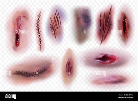 Surgical Stitches Stock Vector Images Alamy