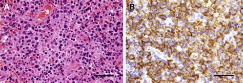 Diffuse Large B Cell Lymphoma Of The Mandible With Periosteal Reaction